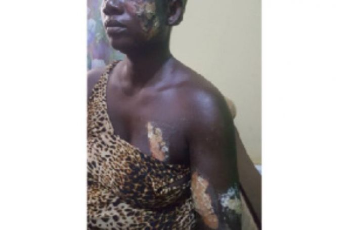 28-Year-Old Man Burns Girlfriend With Hot Electric Iron For Taking His GH¢7